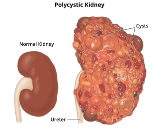 polycystic-kidney